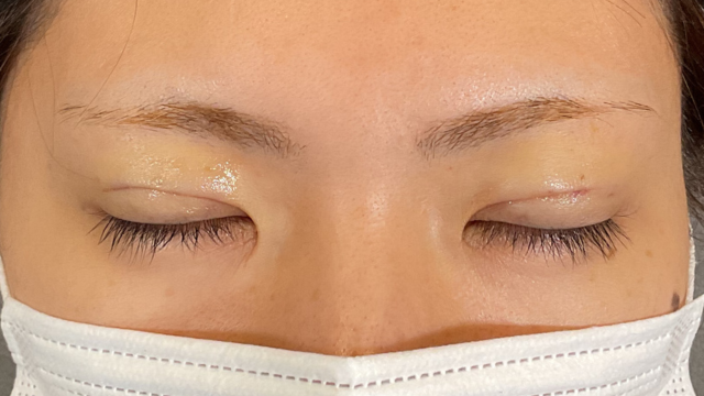 手术前的状态 其一