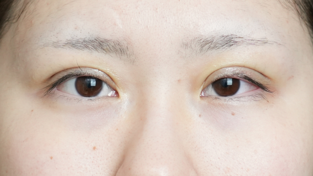 手术前的状态 其一