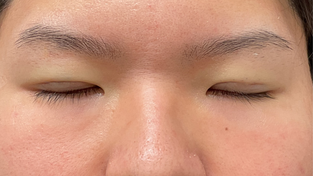 手術前の状態 その1