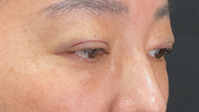 手術前の状態 その1