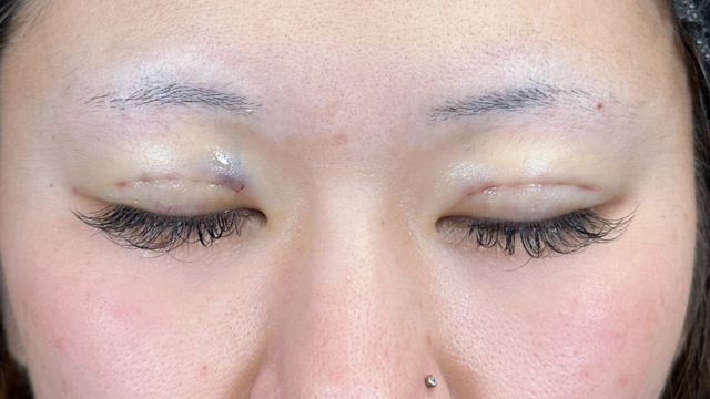 手术前的状态 其一