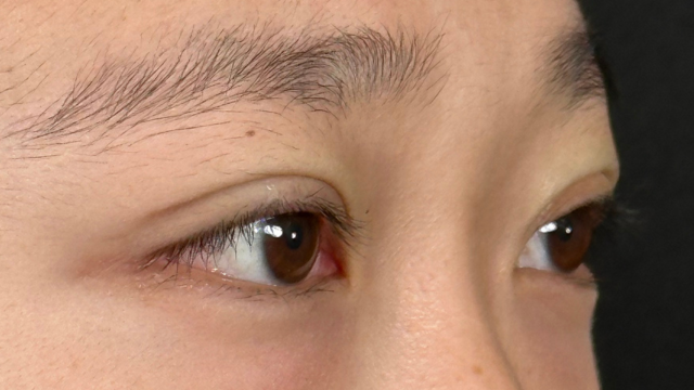 手術前の状態 その1