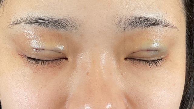 手术前的状态 其一