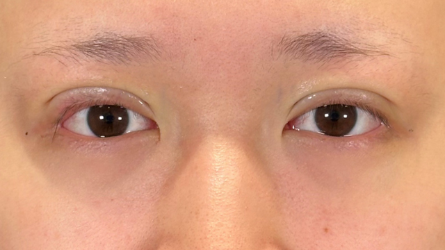 手术前的状态 其一