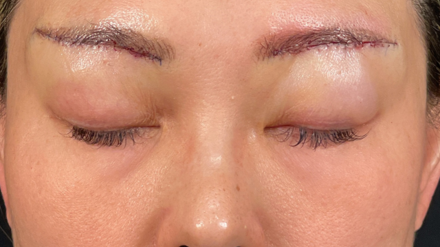 Postoperative Condition Part 1