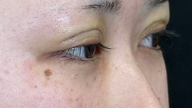 手術前の状態 その1