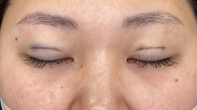 Postoperative Condition Part 1