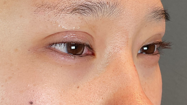 手术前的状态 其一