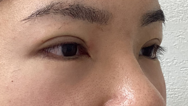 手術前の状態 その1