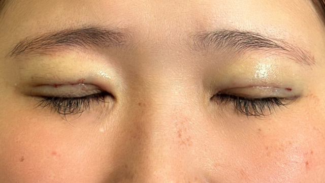 Postoperative Condition Part 1