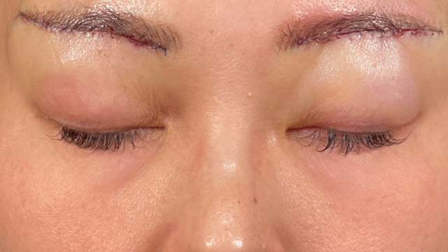 Postoperative Condition Part 1