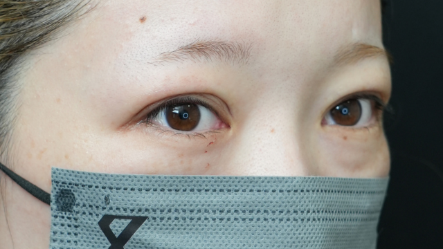 手术前的状态 其一