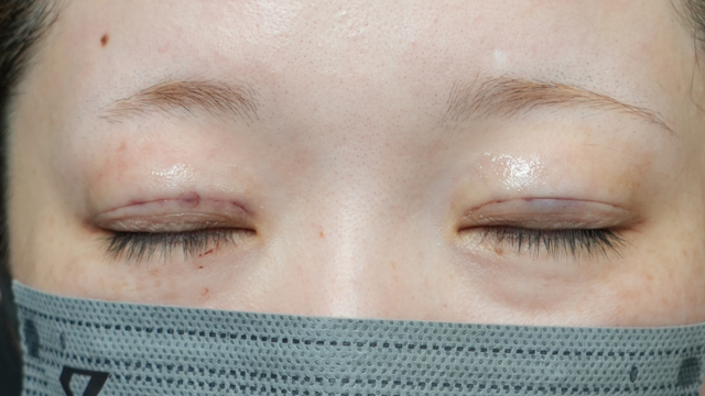 手术前的状态 其一