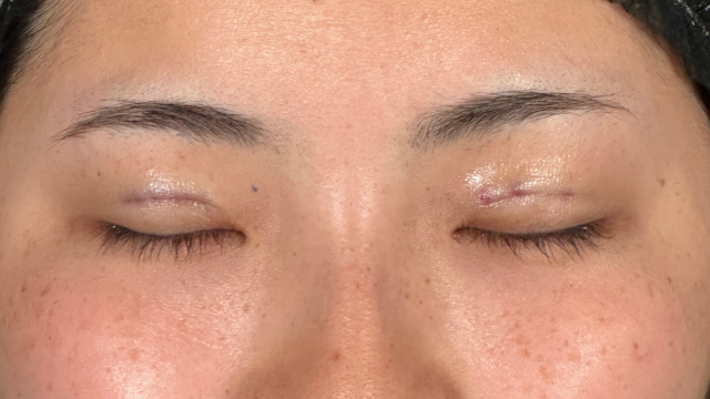 手术前的状态 其一