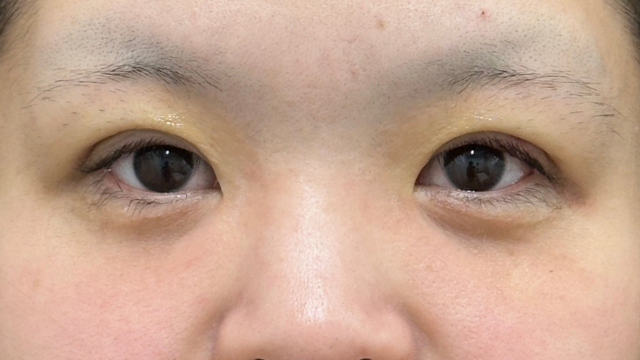 手術前の状態 その1