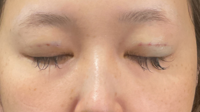 手术前的状态 其一