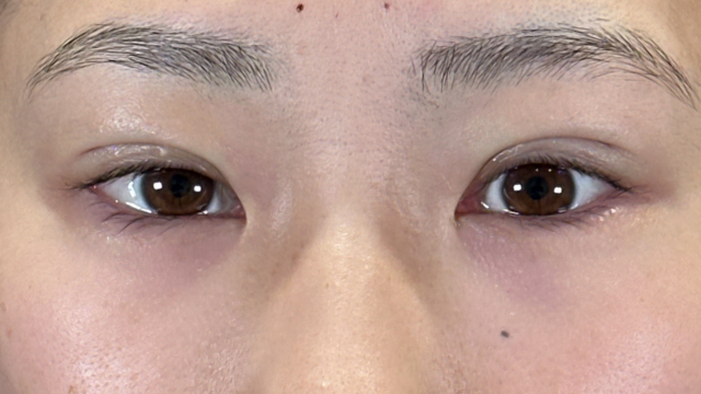 手術前の状態 その1