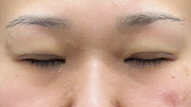 Postoperative Condition Part 1