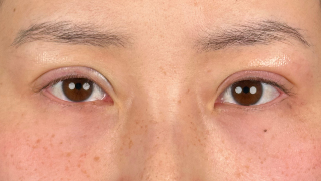 手术前的状态 其一