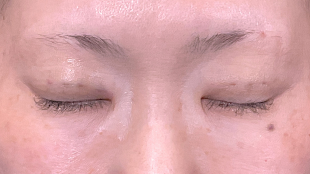 手术前的状态 其一