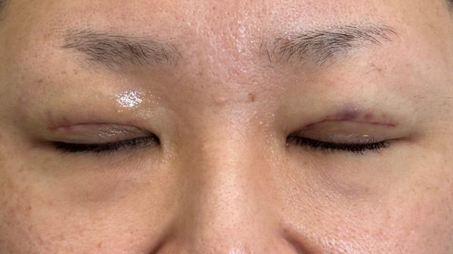 Postoperative Condition Part 1