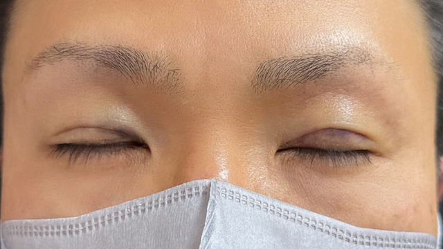 手术前的状态 其一