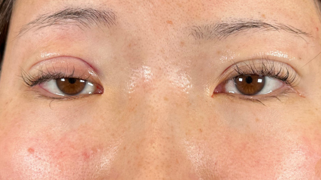 手术前的状态 其一