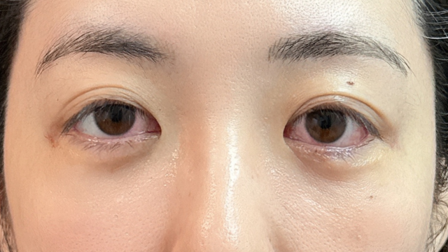 手术前的状态 其一