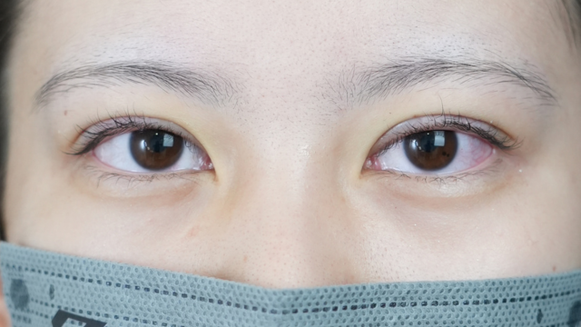 手術前の状態 その1