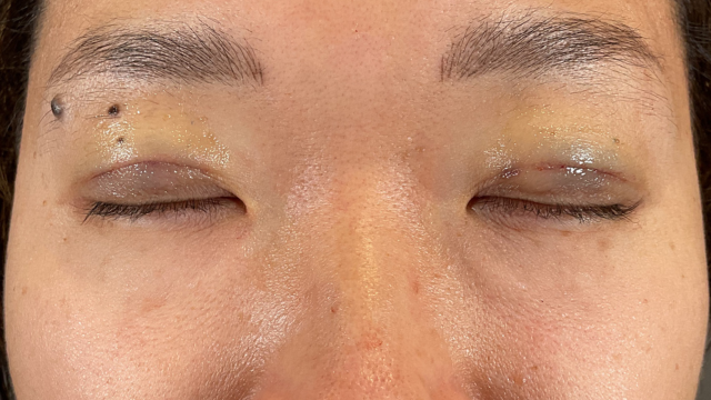 Postoperative Condition Part 1