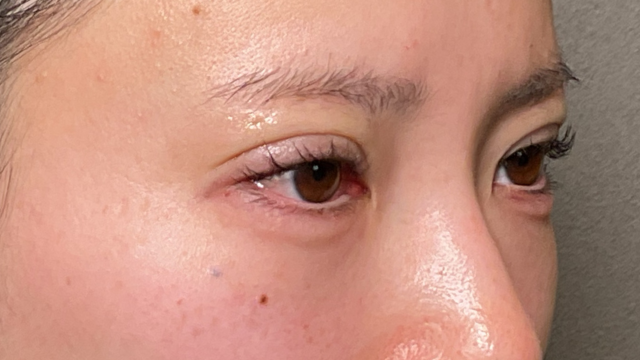 手术前的状态 其一