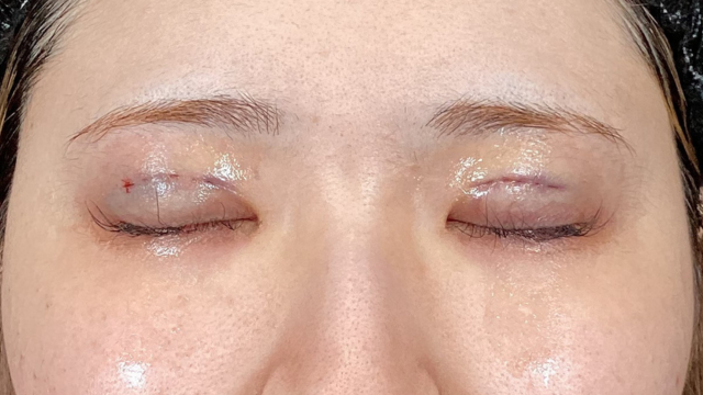 手術前の状態 その1