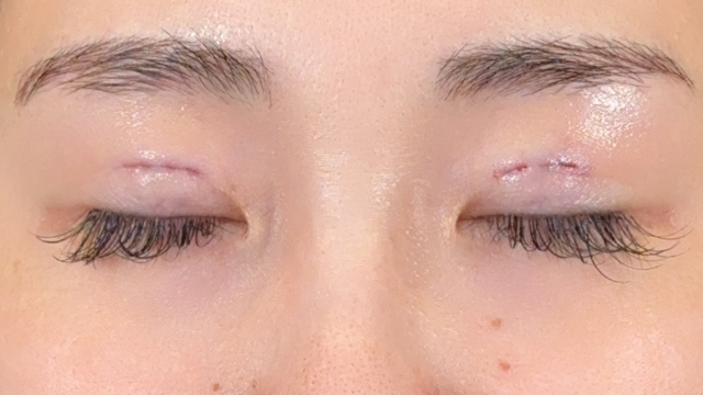 手術前の状態 その1