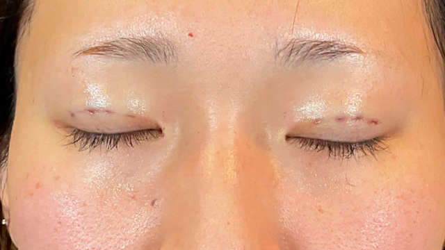 手術前の状態 その1