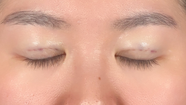 手術前の状態 その1