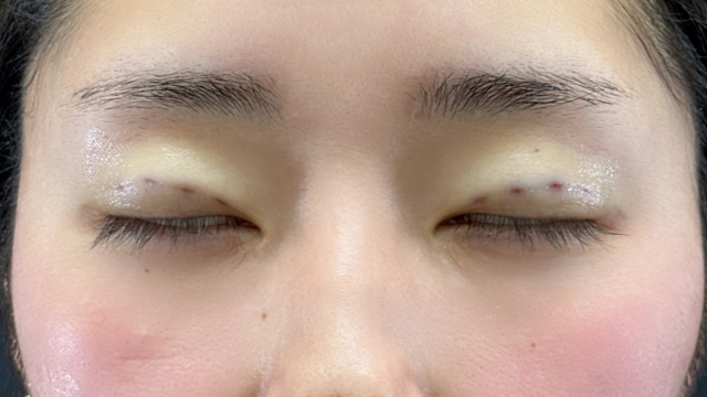 手術前の状態 その1