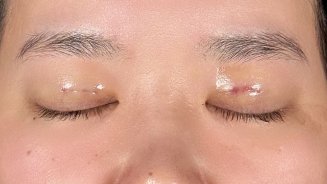 手术前的状态 其一