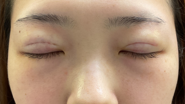 Postoperative Condition Part 1