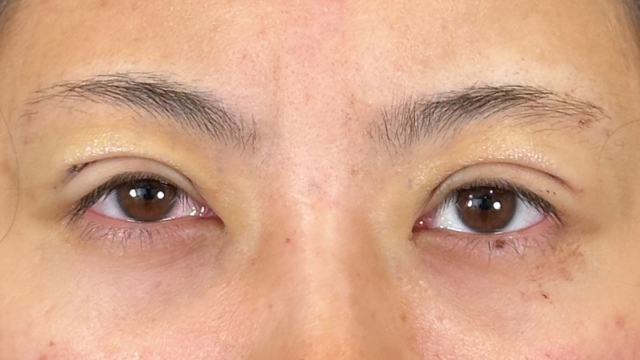 手術前の状態 その1