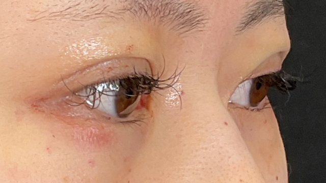 手术前的状态 其一