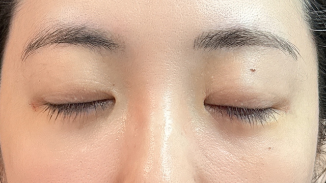 手术前的状态 其一