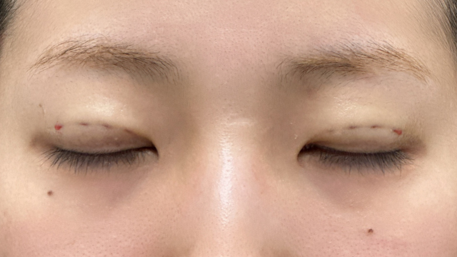 手术前的状态 其一