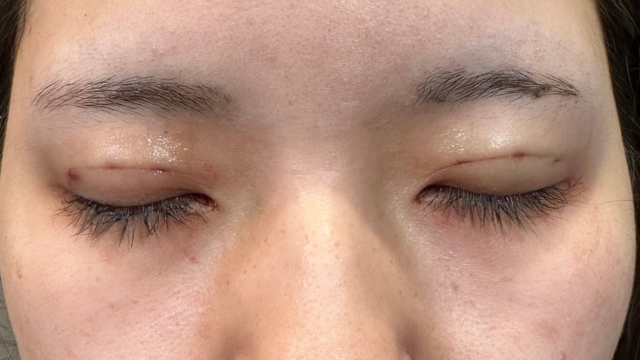 手術前の状態 その1