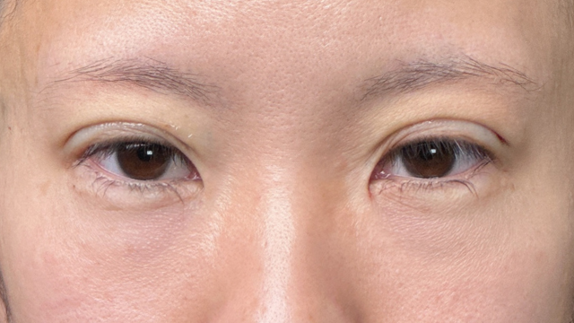 手术前的状态 其一