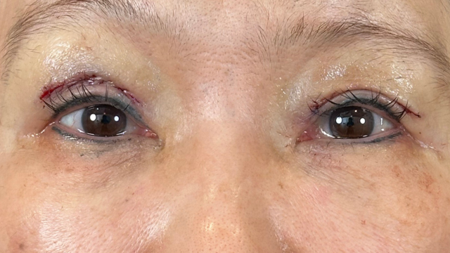 手术前的状态 其一