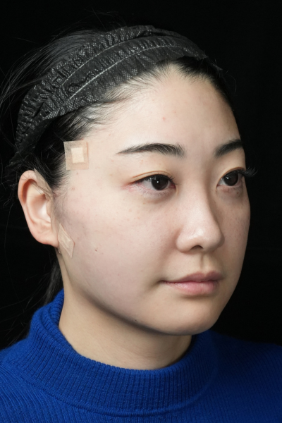 手术前的状态 其一