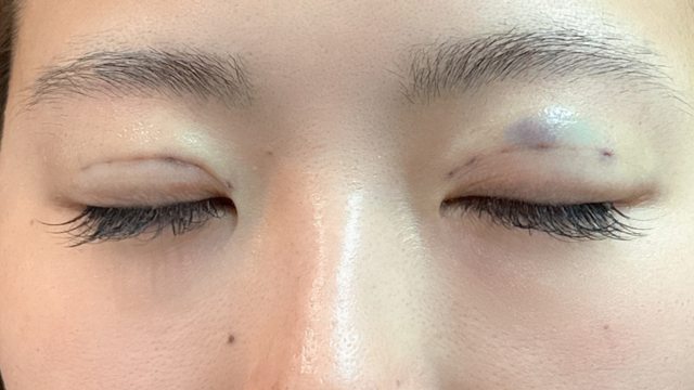 手術前の状態 その1