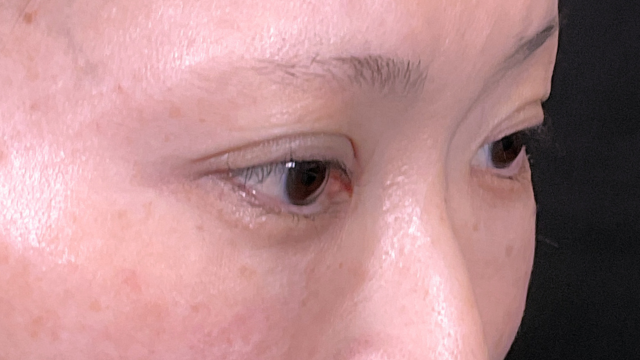 手术前的状态 其一