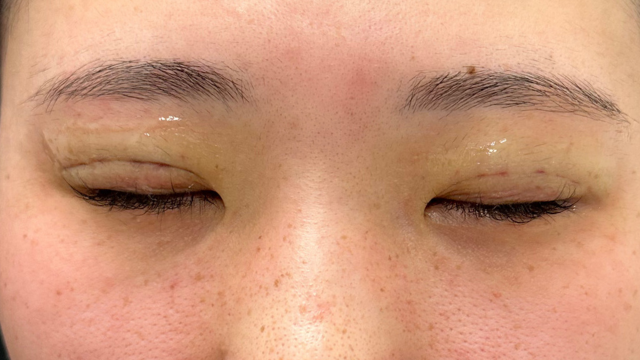 手术前的状态 其一