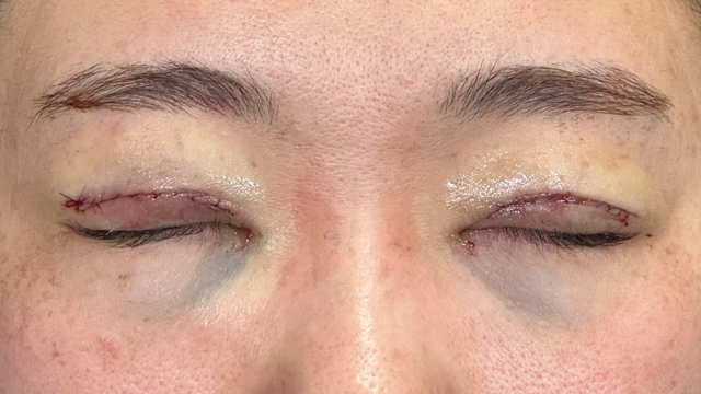 手術前の状態 その1